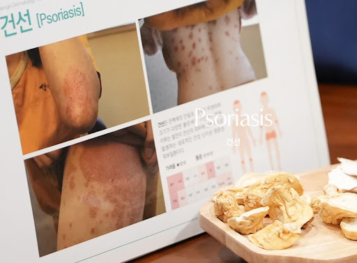 생기한의원으로 보는 건선과 아토피 피부염 차이 기본 정보