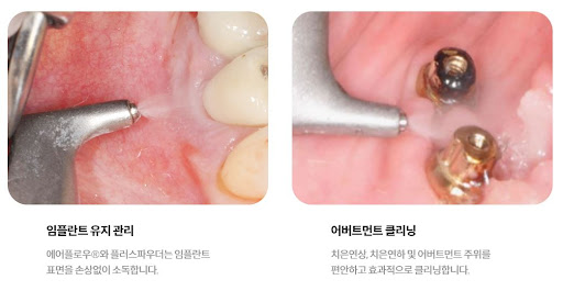 불당본점 서울비디치과의원에서 사랑니발치와 천안 치아교정을 전문으로 제공